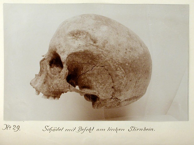 Schädel aus Rimbeck mit Defekt, 1906/07 (Foto: SMB-PK/MVF, IA 10, Bd. 5, E 136/09 (DP 003425)).