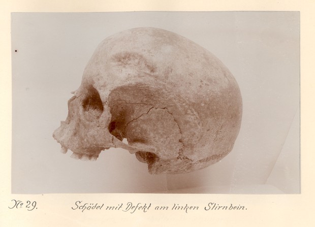 Schädel mit Defekt am linken Stirnbein. Altgrabung (Foto: Götze). Schädel mit Defekt am linken Stirnbein. Altgrabung (Foto: Götze).